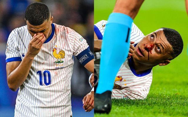 Kylian Mbappe In Hospital After Nose Break At Euro